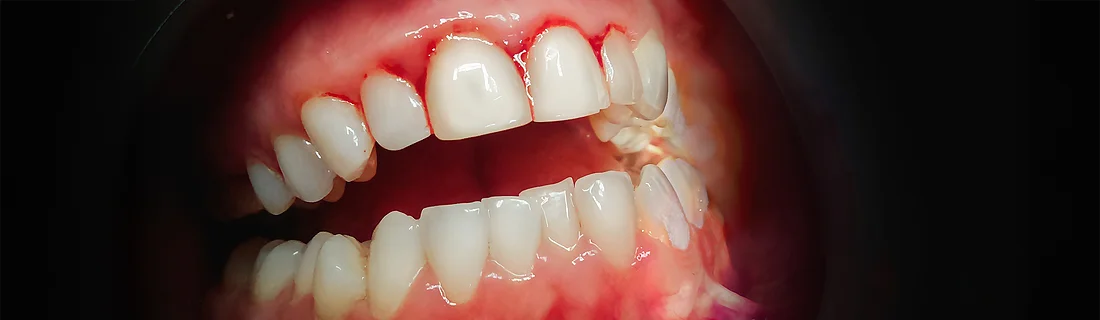 Periodontal Diseases in Vista CA Periodontal Diseases in Vista CA
