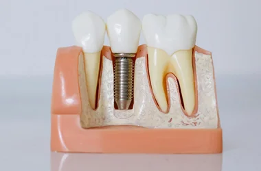 Dentist Vista CA Implants HP A model of a mouth and gums, depicting a dental implant installed between two teeth